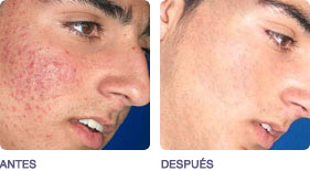 acne_2