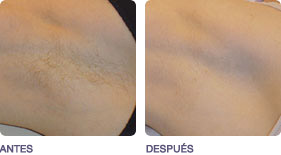 depilacion_sin_dolor_2