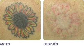 eliminacion_de_tatuajes_2