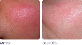 lesiones_vasculares_pigmentadas_2