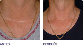 psoriasis_vitiligo_hipopigmentacion_2