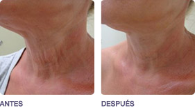 rejuvenecimiento_fraccional_no_ablativo_2