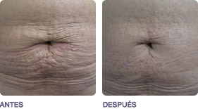 remodelado_corporal_tensado_2