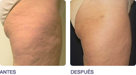 remodelado_corporal_y_drenaje_2