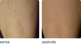 venas_y_varices_2