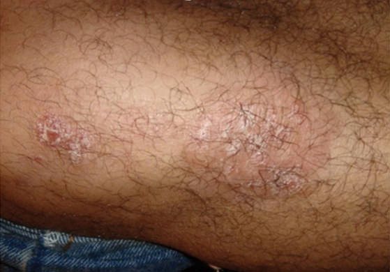 Excimer-psoriasis-antes-3