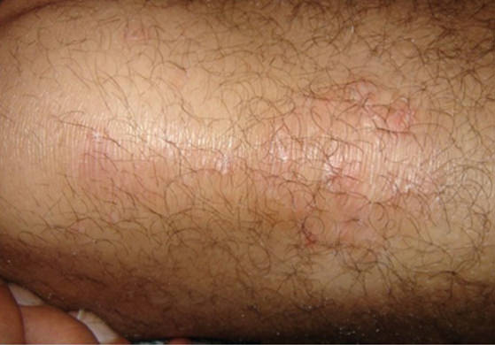 Excimer-psoriasis-despues-3