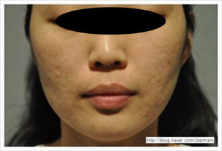 accent-prime-cicatrices-de-acne-antes-1