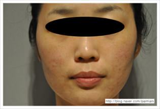 accent-prime-cicatrices-de-acne-despues-1