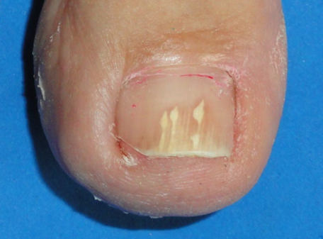 Tratamiento los hongos de las uñas (onicomicosis)