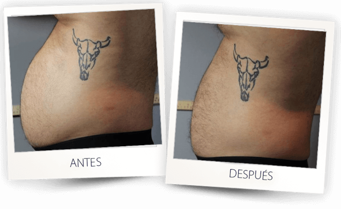 antes y después accent prime grasa abdominal