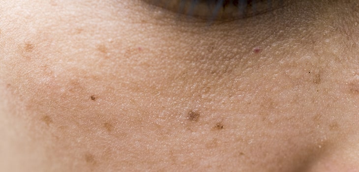 ¿Manchas en la piel? Todo sobre la melanina, tipos de manchas y soluciones