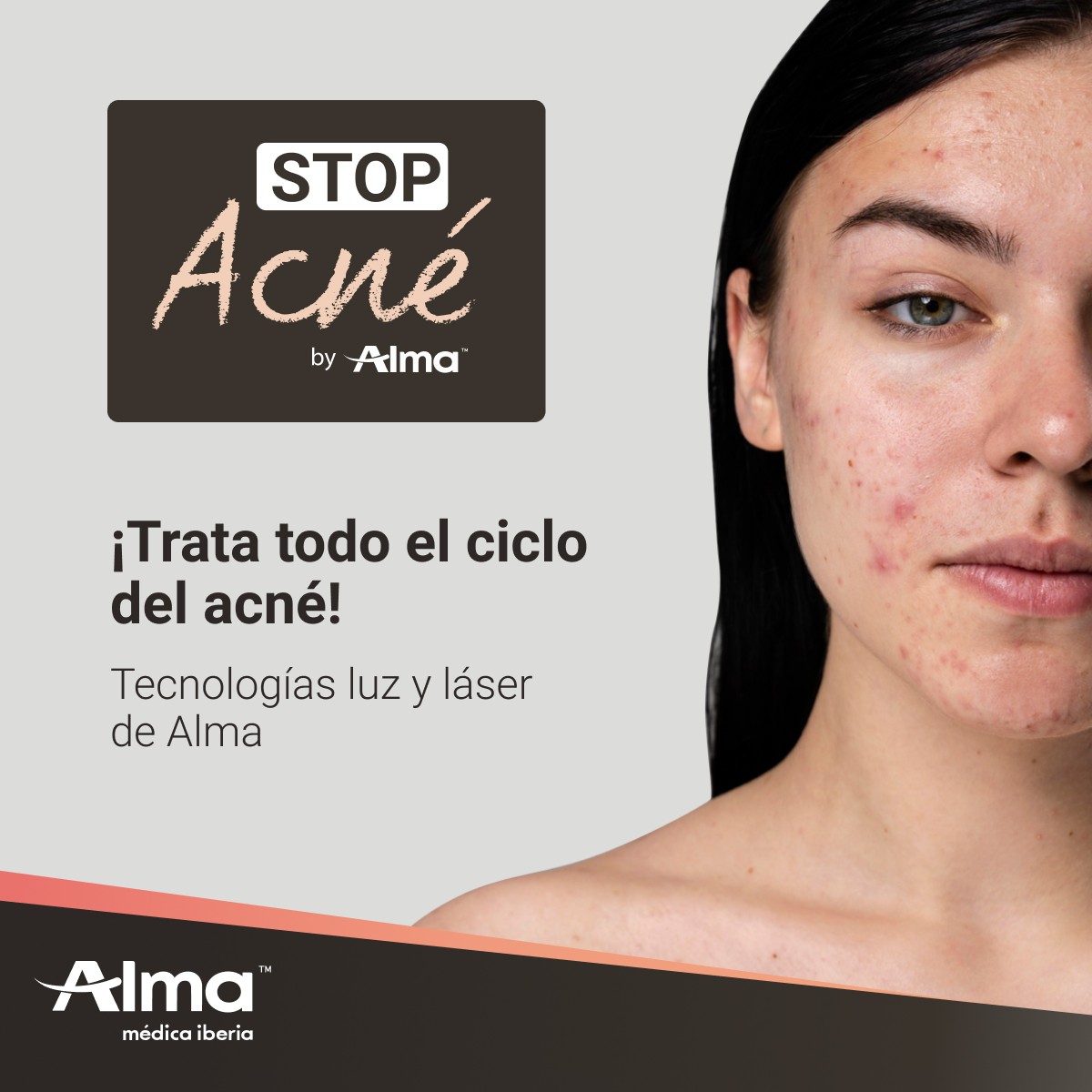 stop-acne-alma