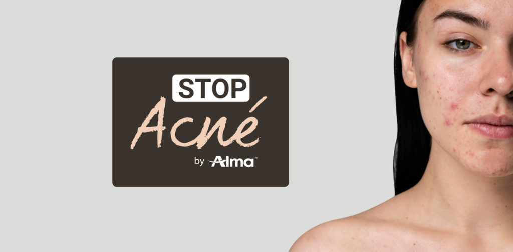 stop-acne-protocolo-alma
