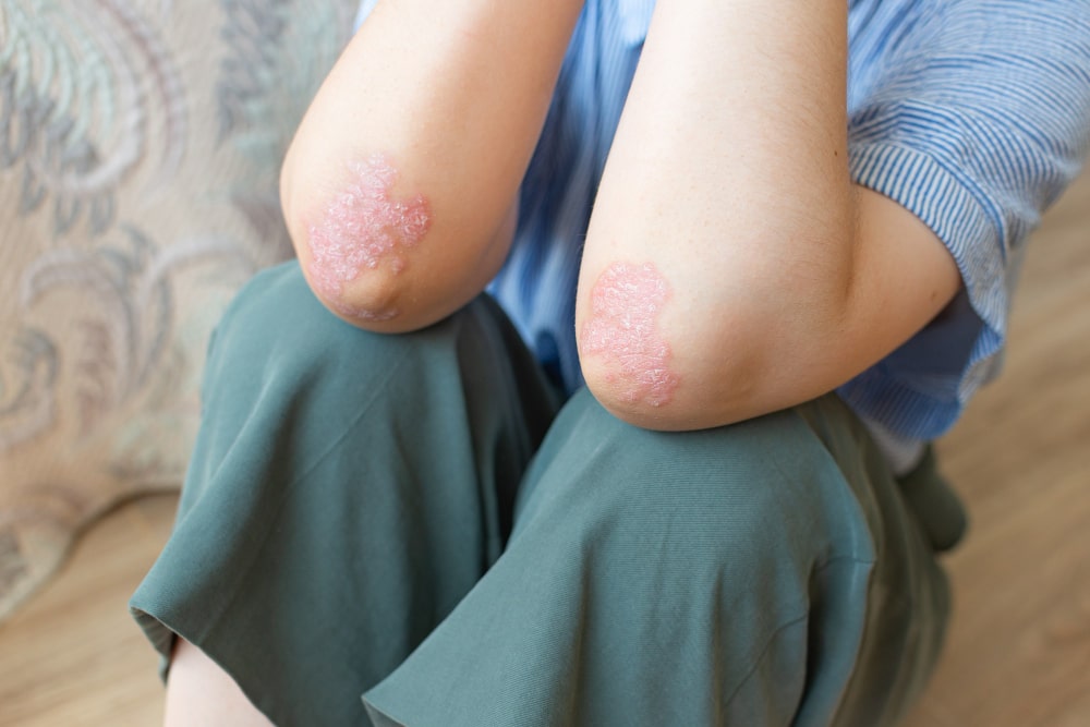 ¿Tiene cura la psoriasis?