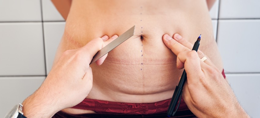 ¿Se puede borrar la cicatriz de una abdominoplastia?