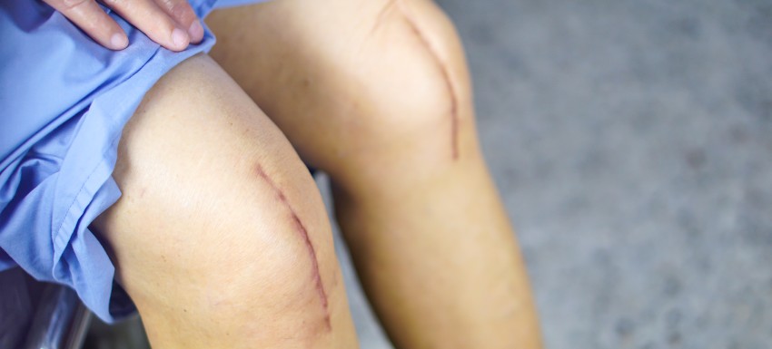 ¿Qué es la fibrosis postquirúrgica y cómo eliminarla?