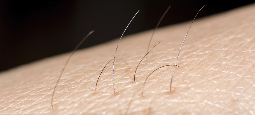 Cómo evitar la foliculitis después de la depilación láser