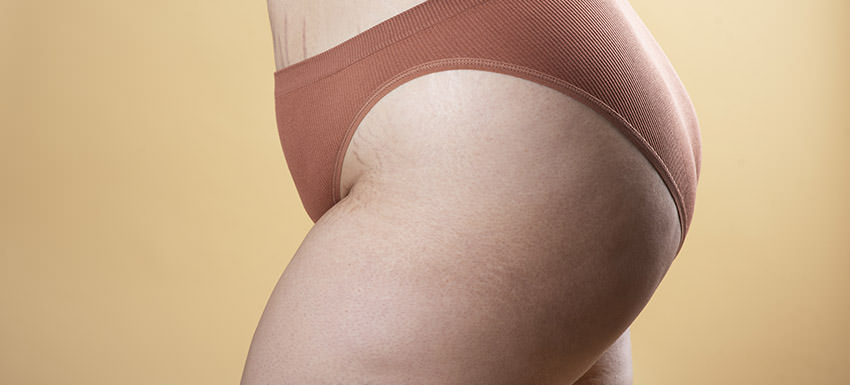 Cómo se realiza un lifting de glúteos sin cirugía