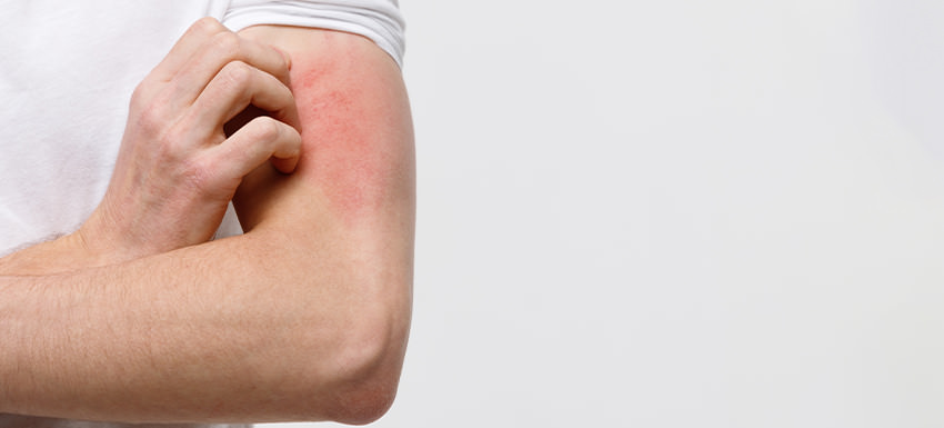 ¿Cuáles son los síntomas y soluciones para la dermatitis?
