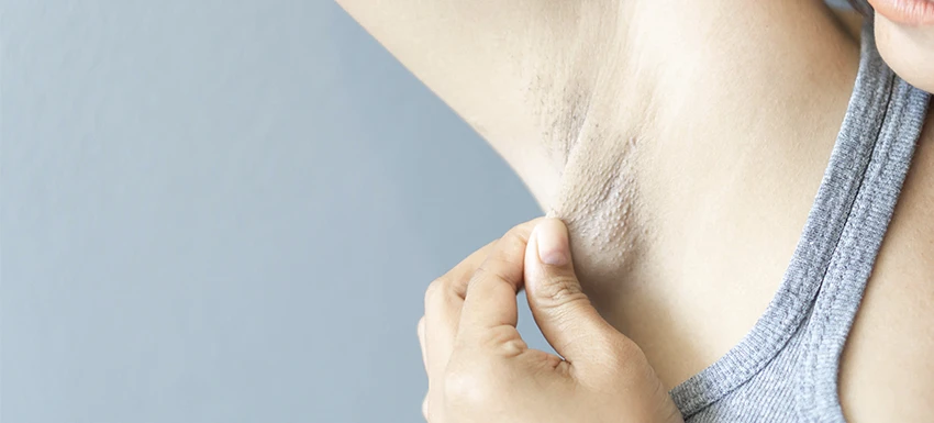 ¿Cómo se elimina la hidradenitis supurativa?