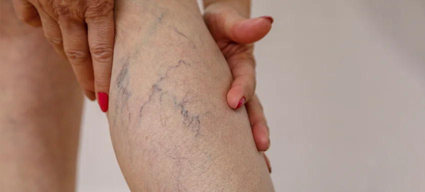 Causas de las varices y cómo prevenirlas de forma efectiva
