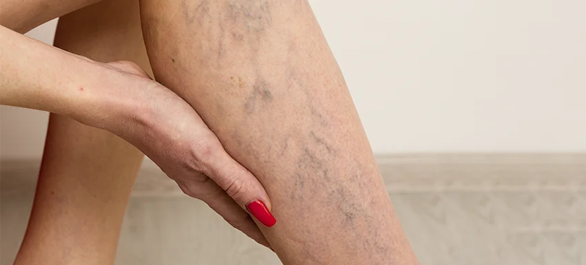 Varices o arañas vasculares: aprende a diferenciarlas y cuándo preocuparte