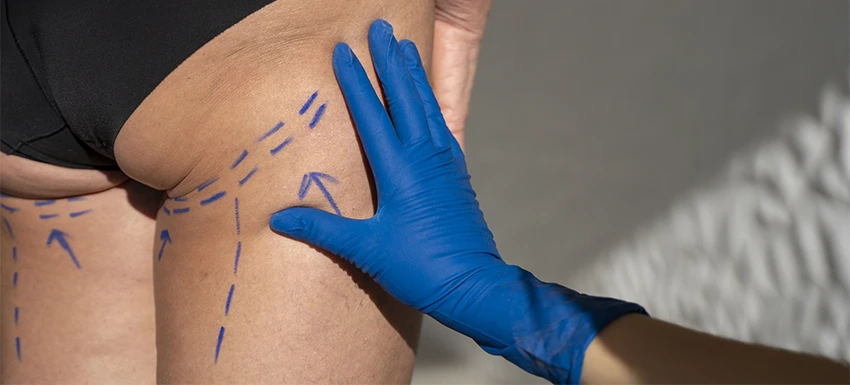 ¿Cuánto cuesta un aumento de glúteos por lipotransferencia?