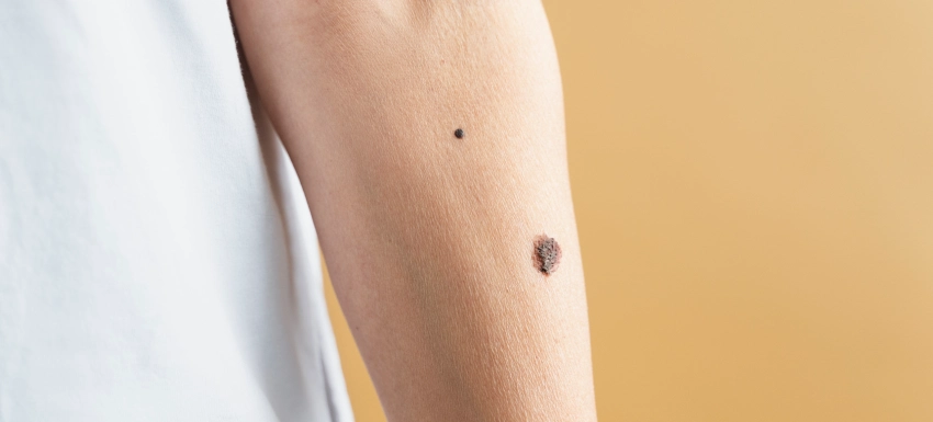 ¿Cuál es el mejor tratamiento para la queratosis seborreica?