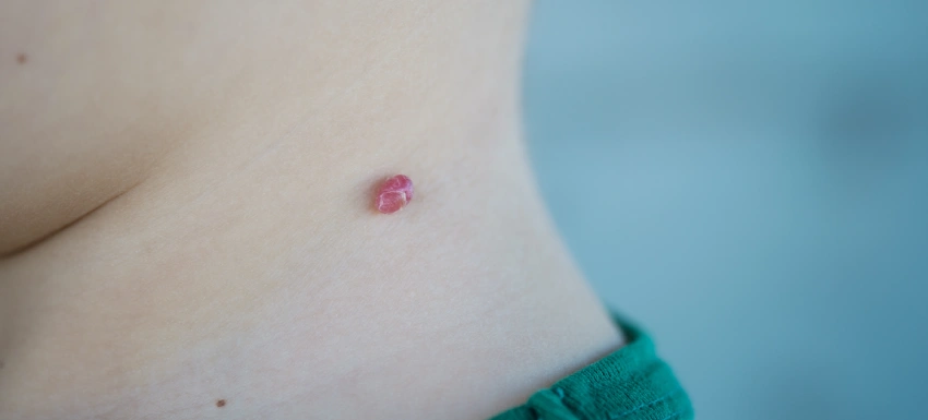¿Cómo se quita un hemangioma?