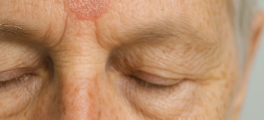 Queratosis actínica: diagnóstico y posibles soluciones