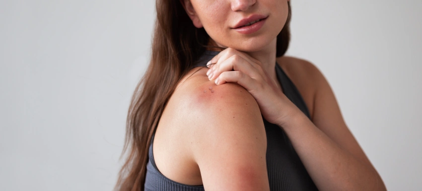 ¿Cómo se elimina el molusco contagioso?