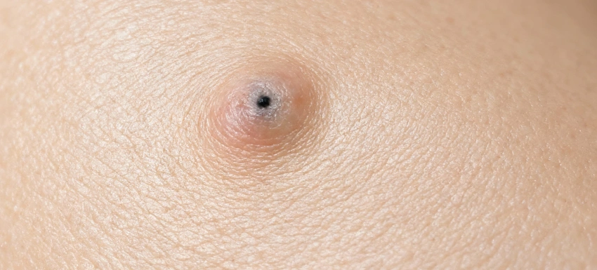¿Cómo se eliminan los quistes epidermoides?