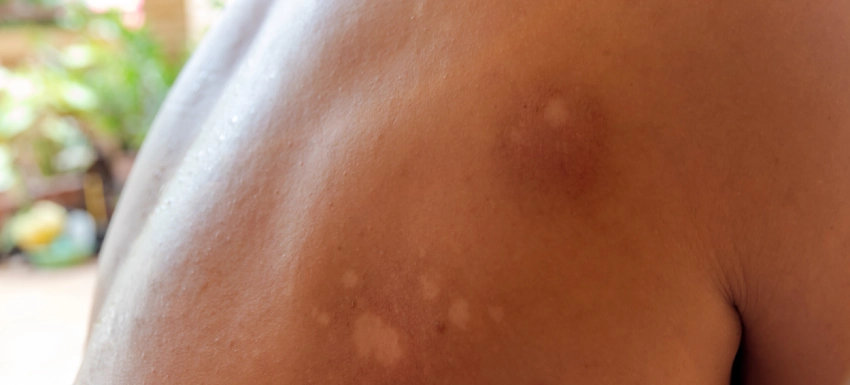 ¿Cómo se quita la pitiriasis versicolor?