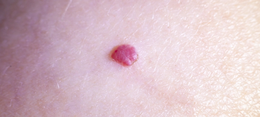 ¿Qué hacer si tengo angiomas?