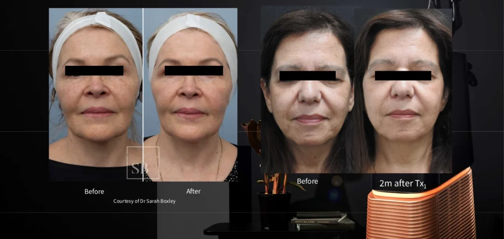 Protocolo de Resurfacing: Winter Reset 3 Comparación de antes y después de tratamiento estético winter reset de resufacing en dos mujeres adultas con mejora visible en textura y firmeza de la piel.