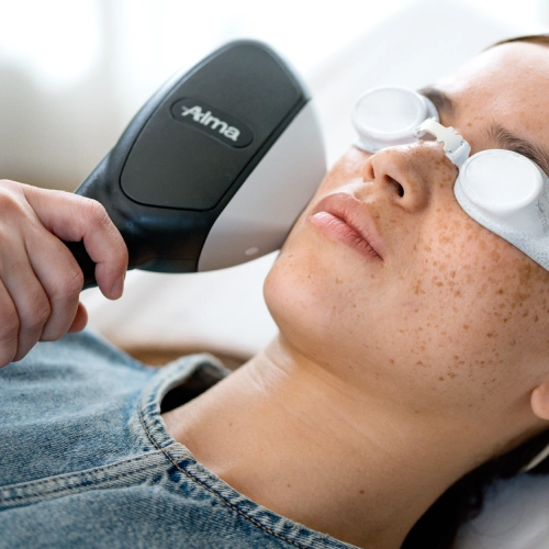 ¿Qué tratamientos faciales hacerte antes de una boda? 2 Persona con gafas protectoras recibiendo un tratamiento láser facial para reducir manchas en la piel.