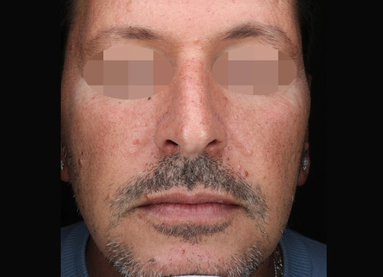 Fotografía clínica estandarizada: cómo documentar la evolución sin introducir sesgos 33 despues-alma-harmony